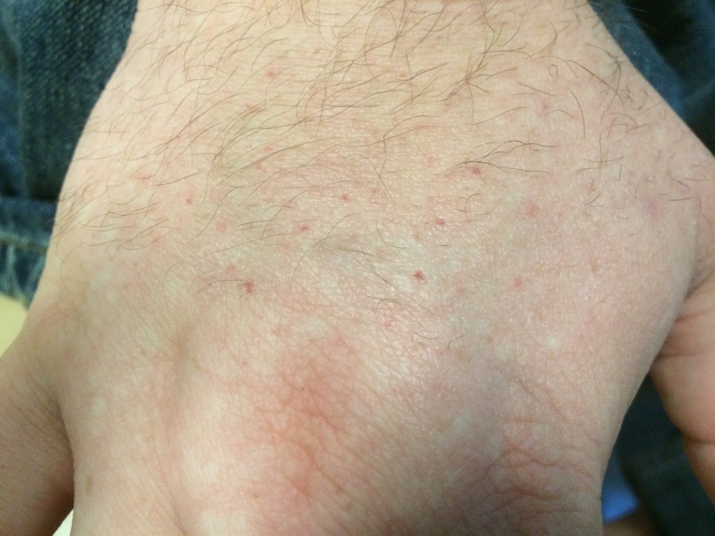 Rheumatoid Skin Rash