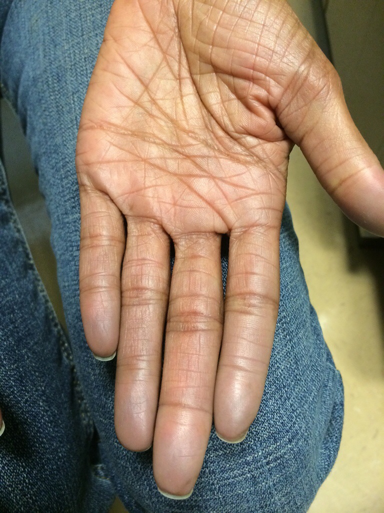 21. Raynaudâ€™s. Bluish discoloration of fingers seen in a patient ...